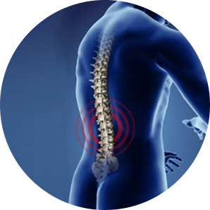 3D model showing the radiating pain caused by sciatica