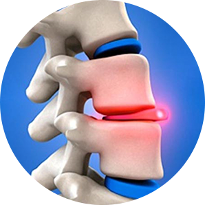 3D model of a spine showing a herniated disc